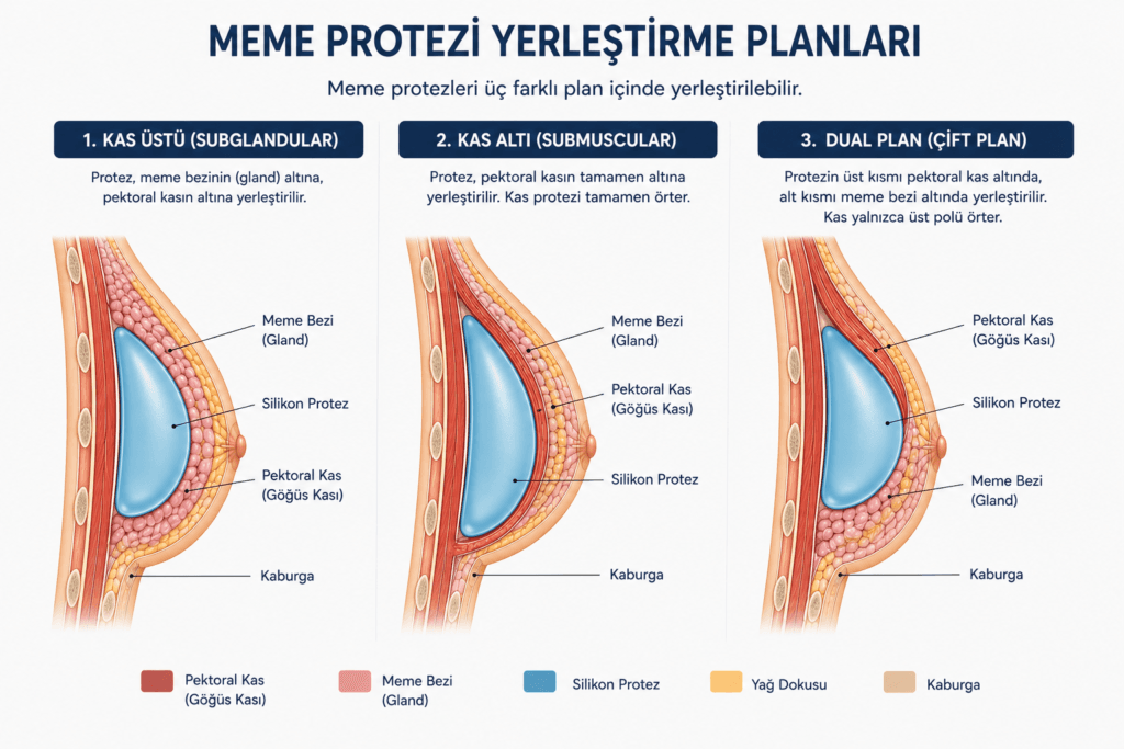 Kas üstü, kas altı (submuskular) ve dual plan meme protezi yerleşimini karşılaştıran tıbbi illüstrasyon.