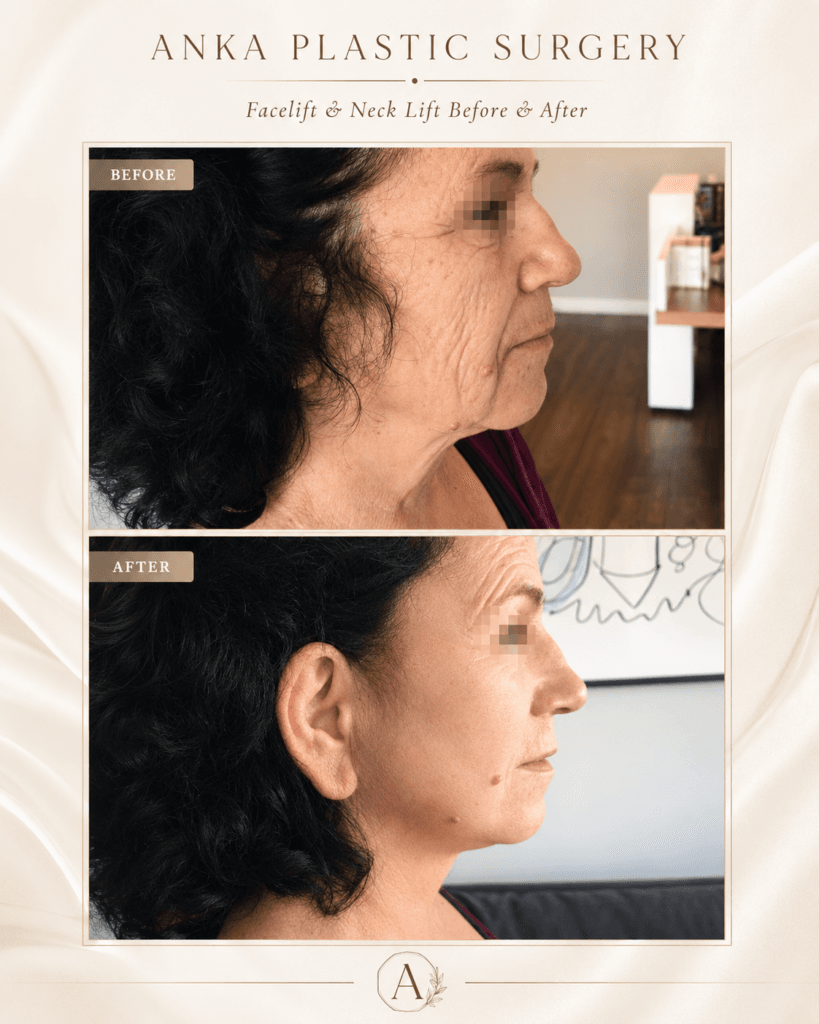 Facelift and neck lift before and after showing improvement in jowls, jawline definition and lower face contour.