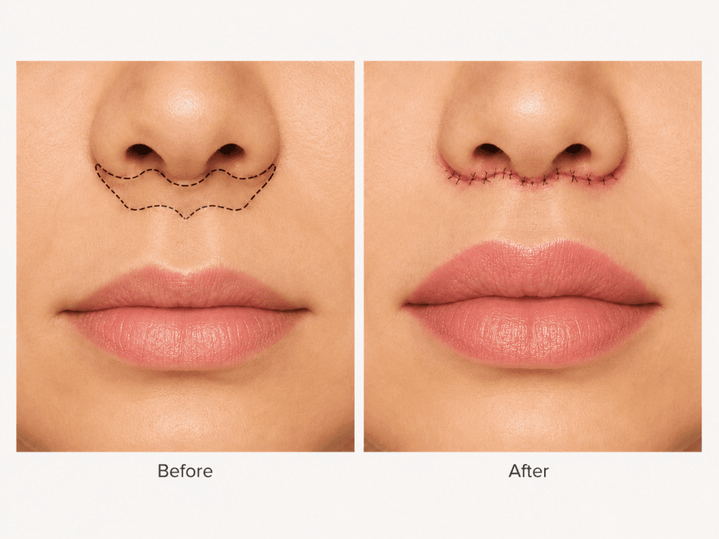 Bullhorn lip lift showing the planned subnasal skin excision and postoperative suture line beneath the nose