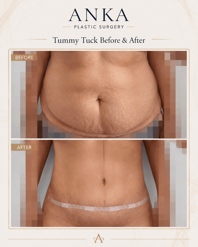 Tummy tuck before and after result showing improved abdominal contour after abdominoplasty surgery