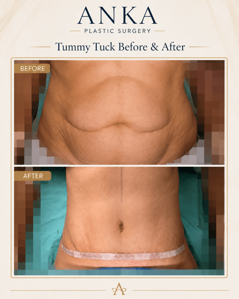 Abdominoplasty before and after photo showing removal of excess abdominal skin and improved waistline contour