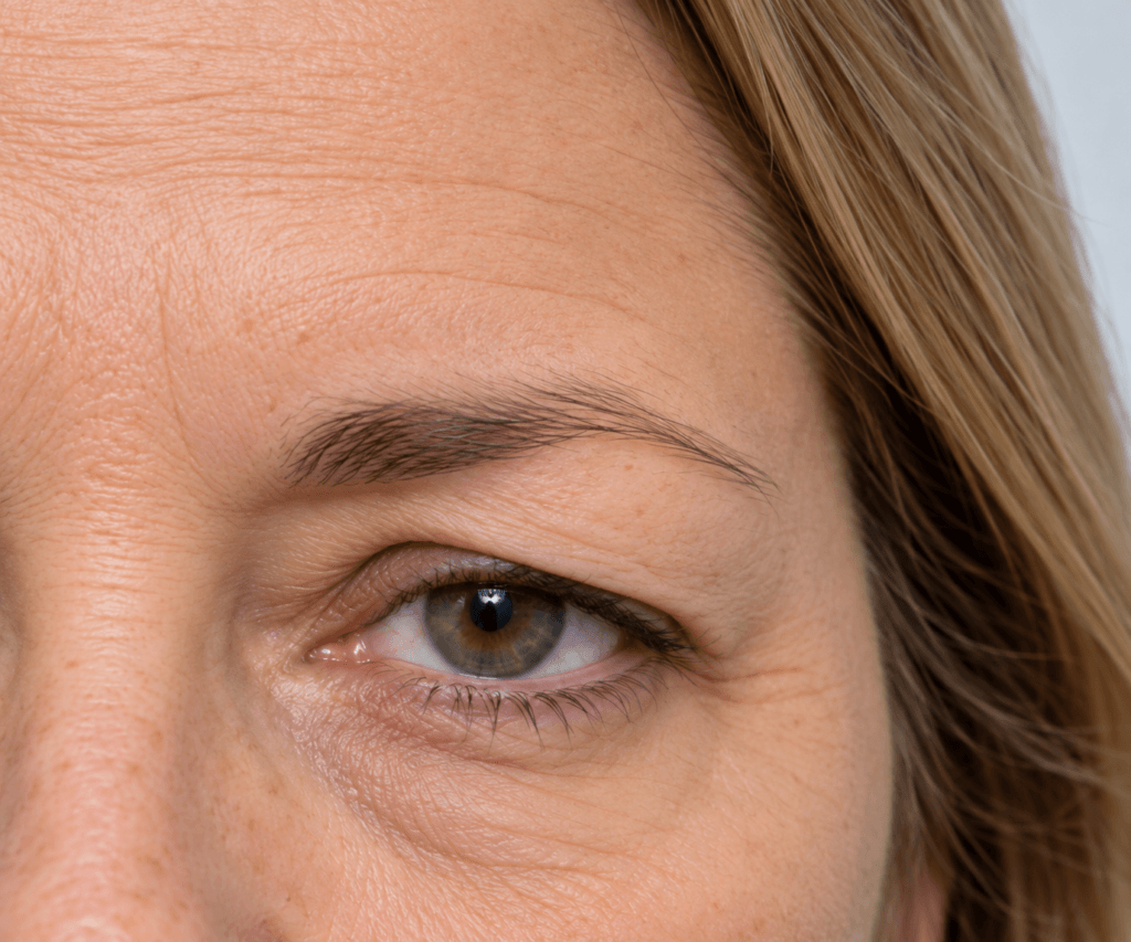Close-up view of a woman with unilateral brow ptosis and associated upper eyelid skin excess on the affected side.
