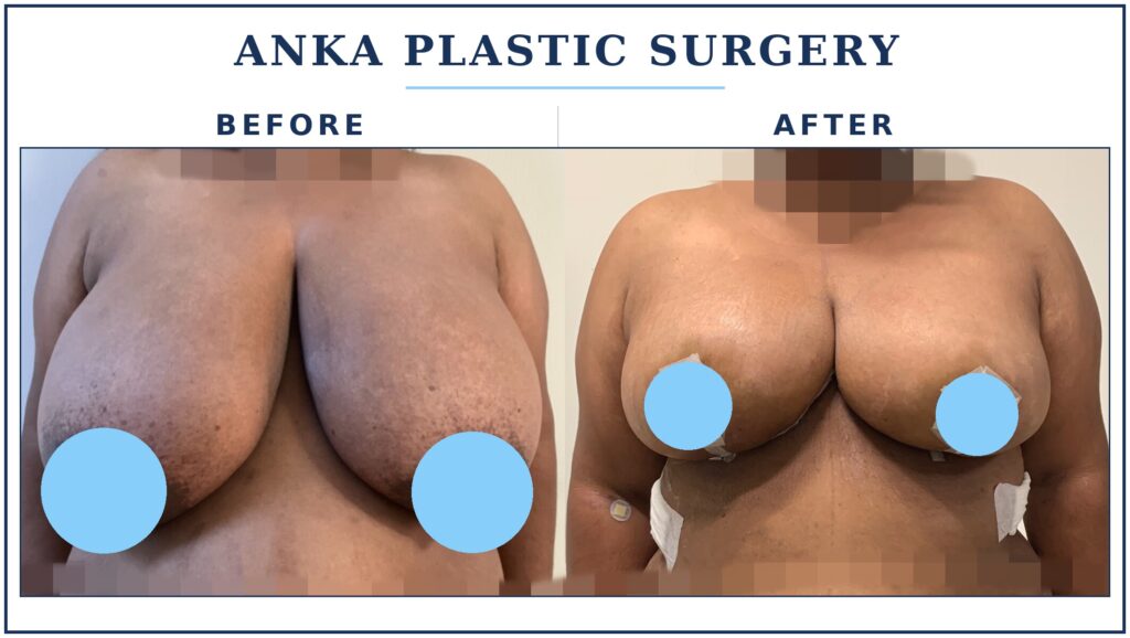 Before and after results of breast reduction surgery showing a more proportionate breast size and improved upper body balance