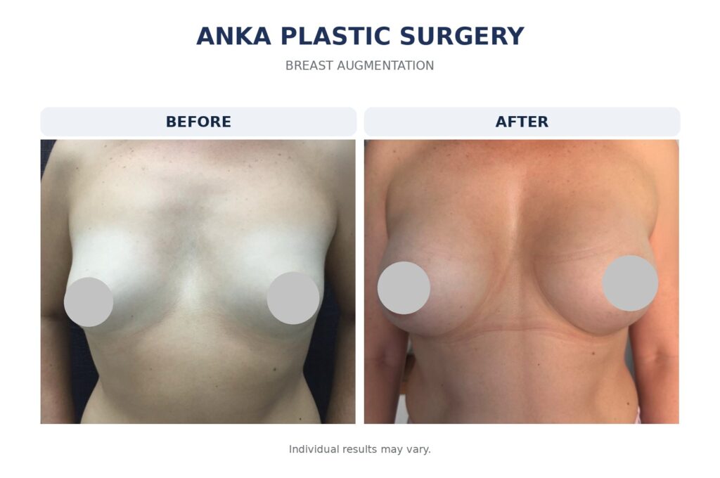 Before and after breast augmentation results at Anka Plastic Surgery, showing fuller, more balanced breast volume and shape