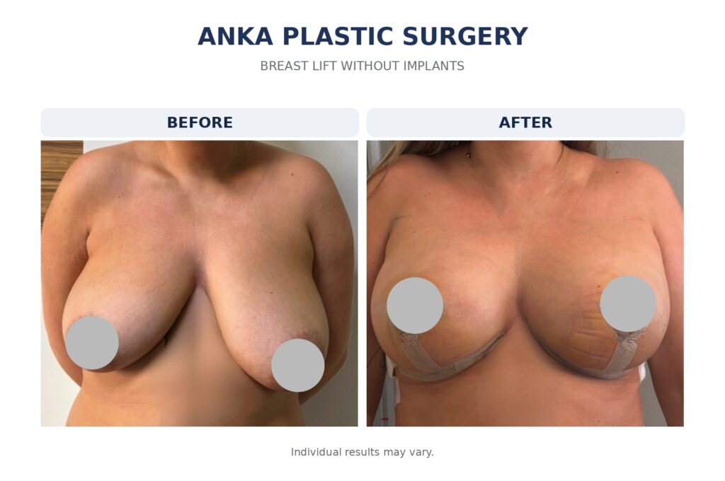 Before and after breast lift without implants at Anka Plastic Surgery, showing lifted breasts and a higher nipple position
