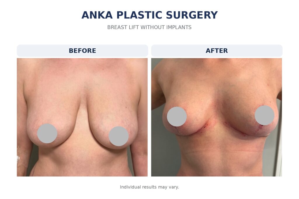 Breast lift without implants before and after results at Anka Plastic Surgery, showing improved breast position and shape