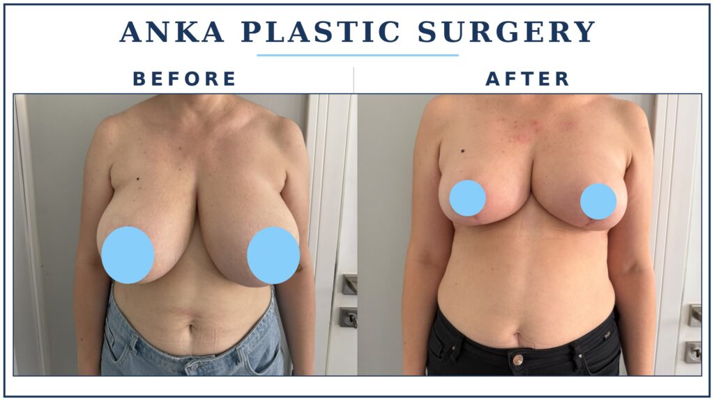 Before and after breast reduction results at Anka Plastic Surgery, showing smaller, lifted and more proportionate breasts