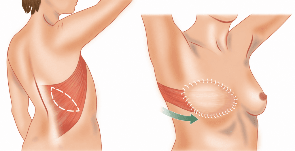 Medical illustration showing breast reconstruction with a latissimus dorsi flap, where tissue and muscle are transferred from the back to the chest.