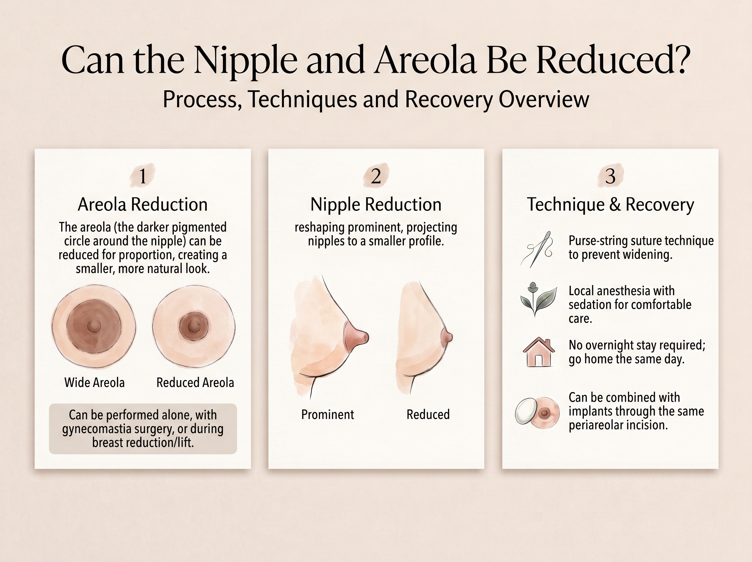 Medical infographic showing nipple and areola reduction, areola diameter, nipple projection and permanent purse-string suture technique